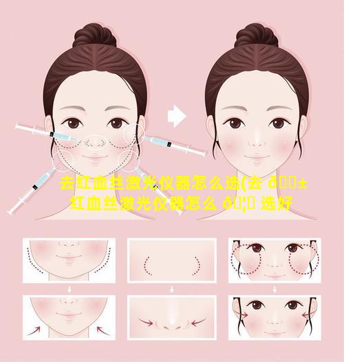 去红血丝激光仪器怎么选(去 🐱 红血丝激光仪器怎么 🦟 选好)